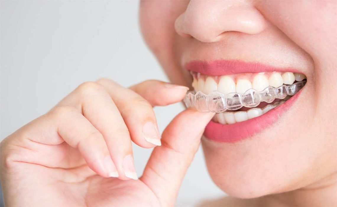 What Insurance covers Invisalign?
