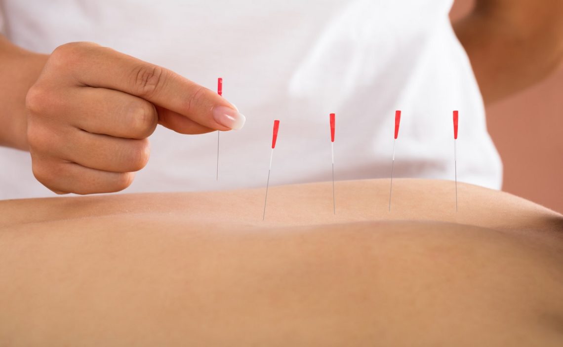 Is Dry Needling Covered by Insurance?