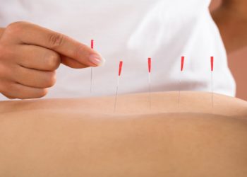 Is Dry Needling Covered by Insurance?